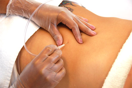 Carboxiterapia