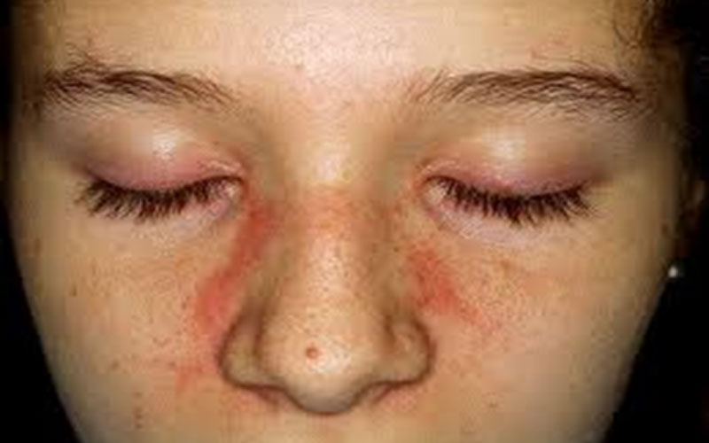 Dermatitis Seborreica