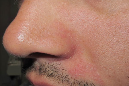 Dermatitis Seborreica